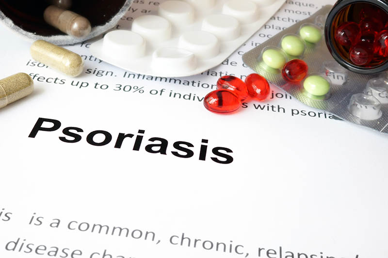 Psoriasis Treatments